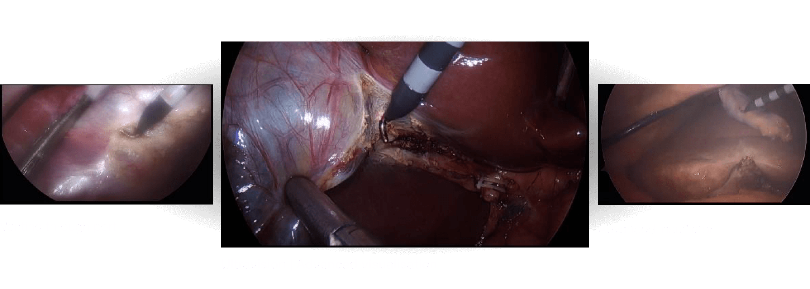 Performance data - Alesi Surgical